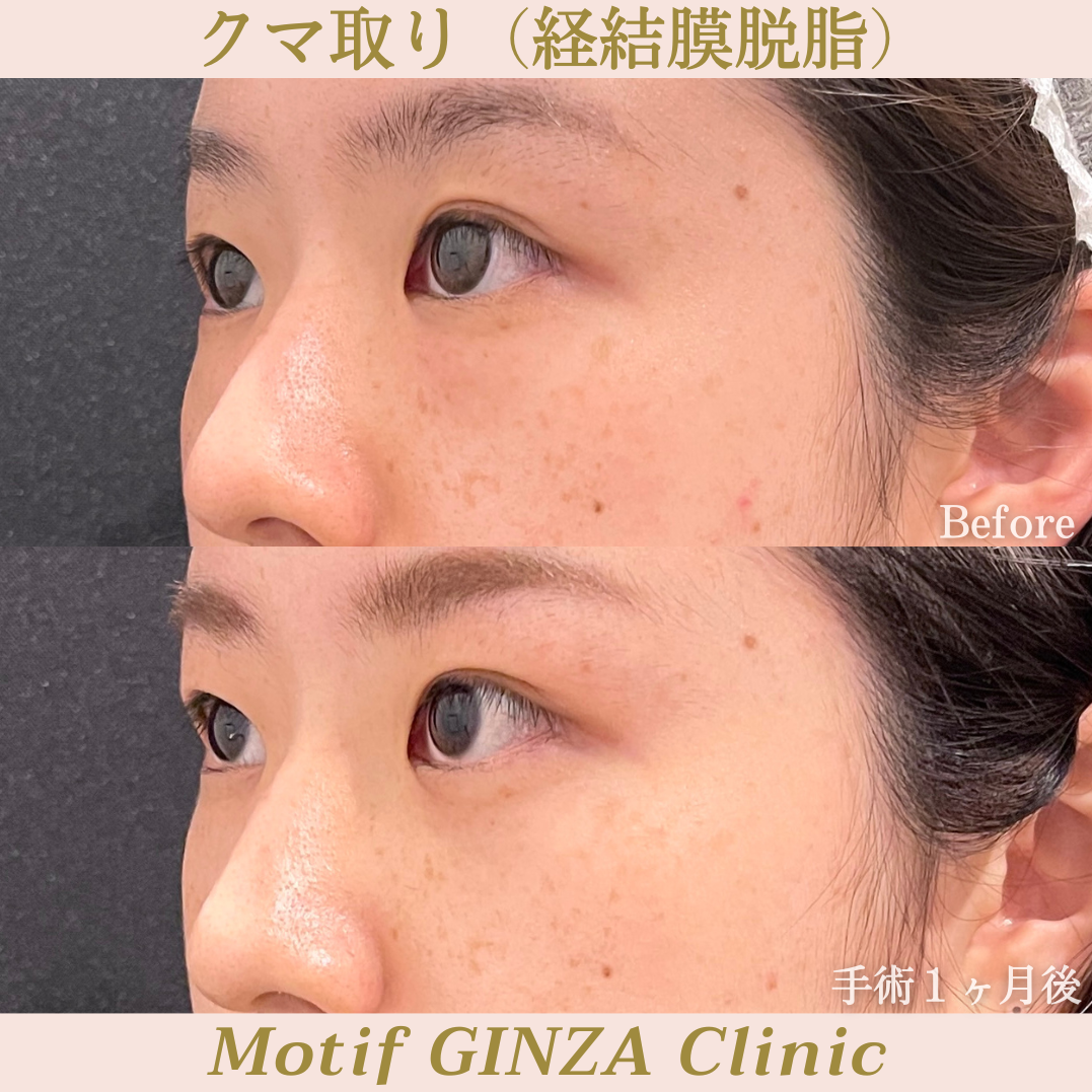 経結膜脱脂（手術１ヶ月）の写真2