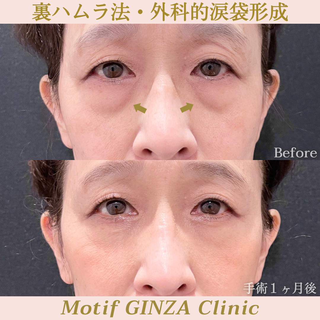 裏ハムラ法・外科的涙袋形成（手術１ヶ月）の写真