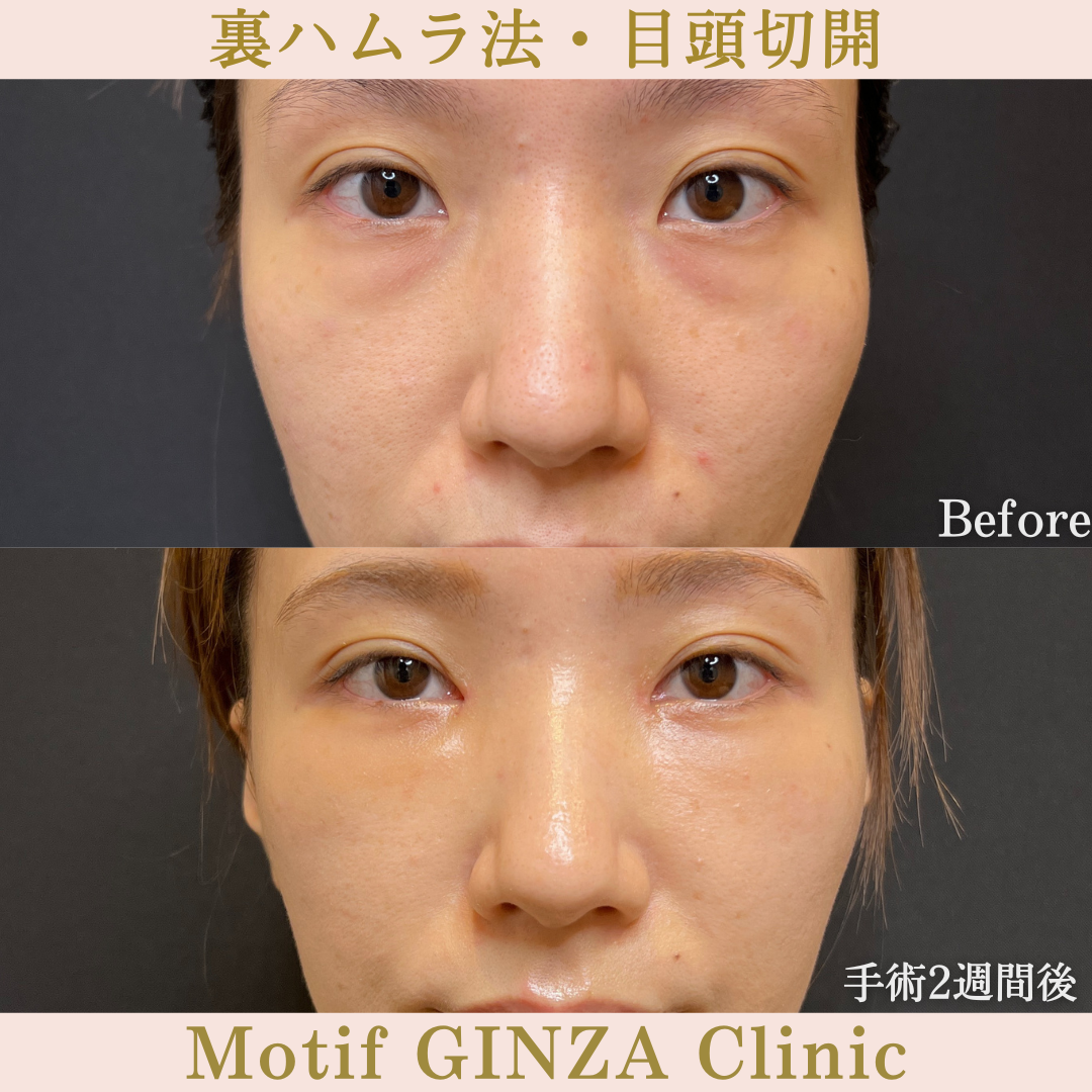 裏ハムラ法・目頭切開(手術6ヶ月)の写真5