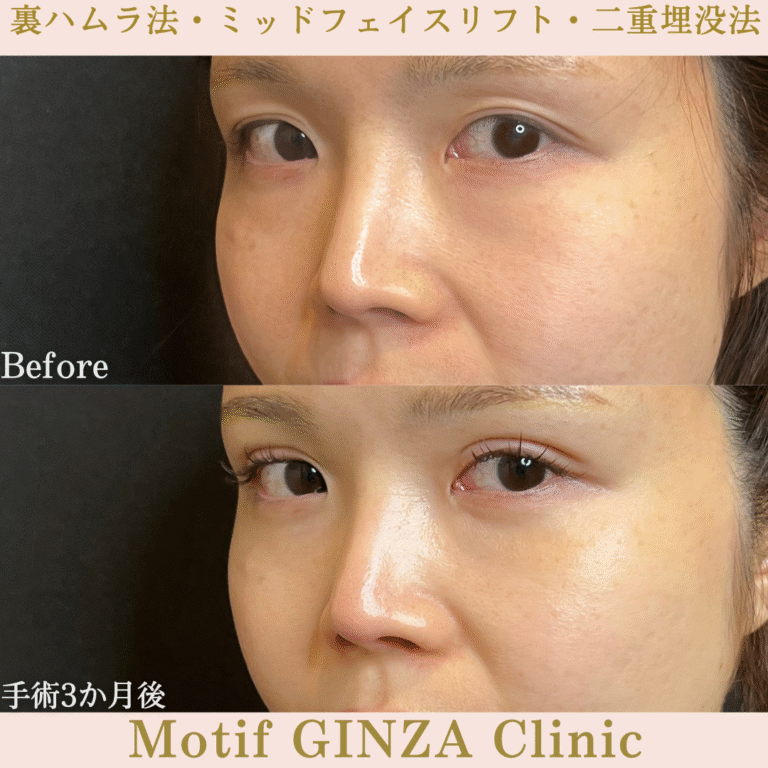 裏ハムラ法・ミッドフェイスリフト・二重埋没法（手術３か月）の写真2