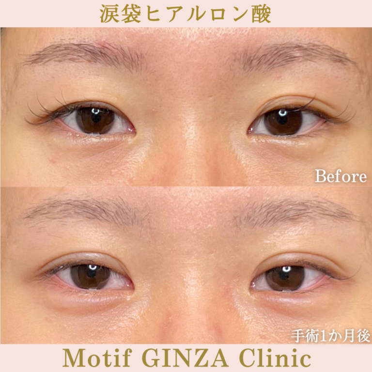 涙袋ヒアルロン酸（手術１か月）