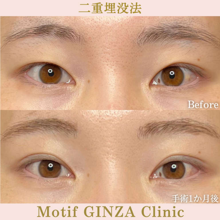 二重埋没法法（手術1か月）