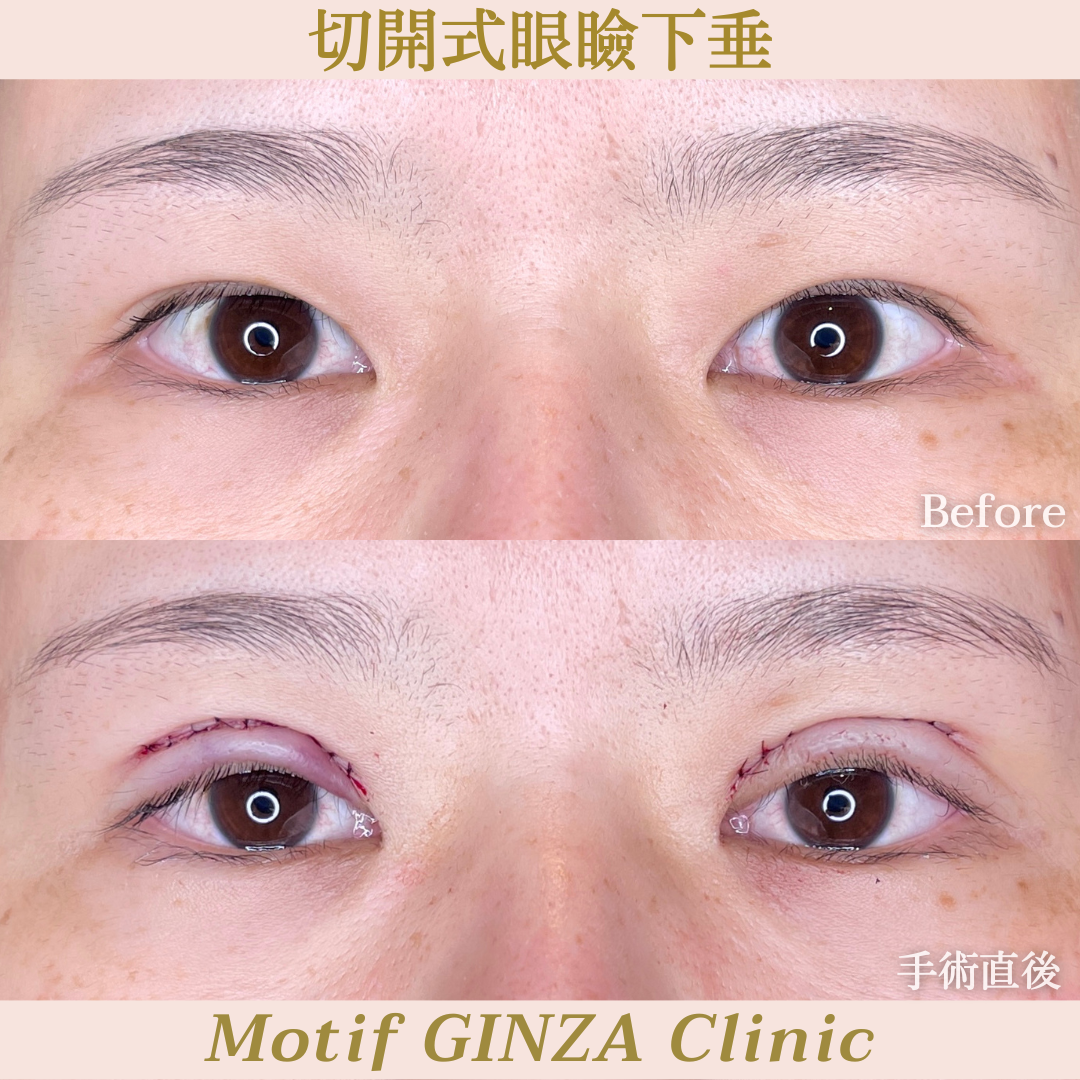 切開式眼瞼下垂手術（手術３ヶ月）の写真5