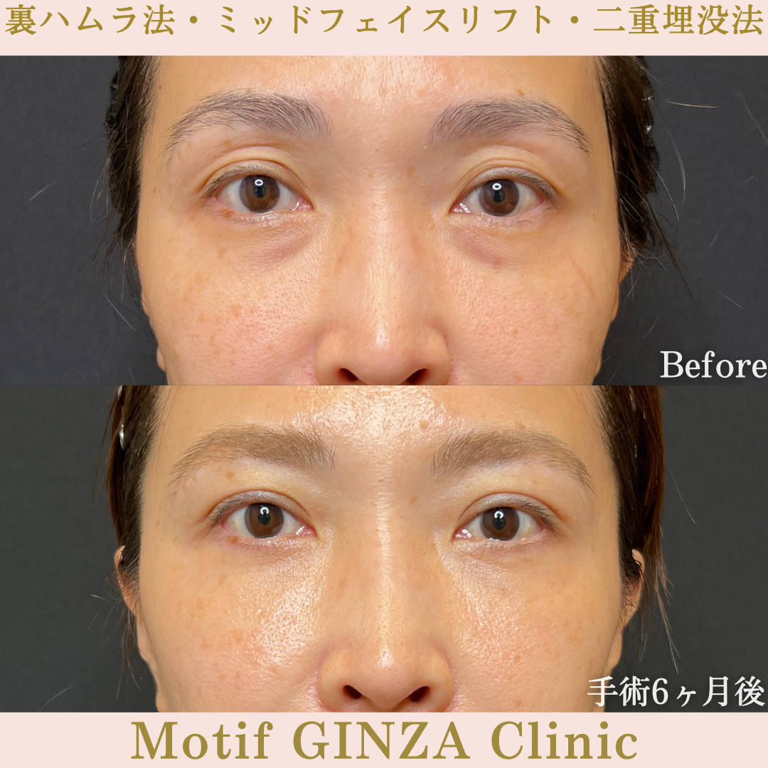 裏ハムラ法・ミッドフェイスリフト・二重埋没法（手術６ヶ月）の写真