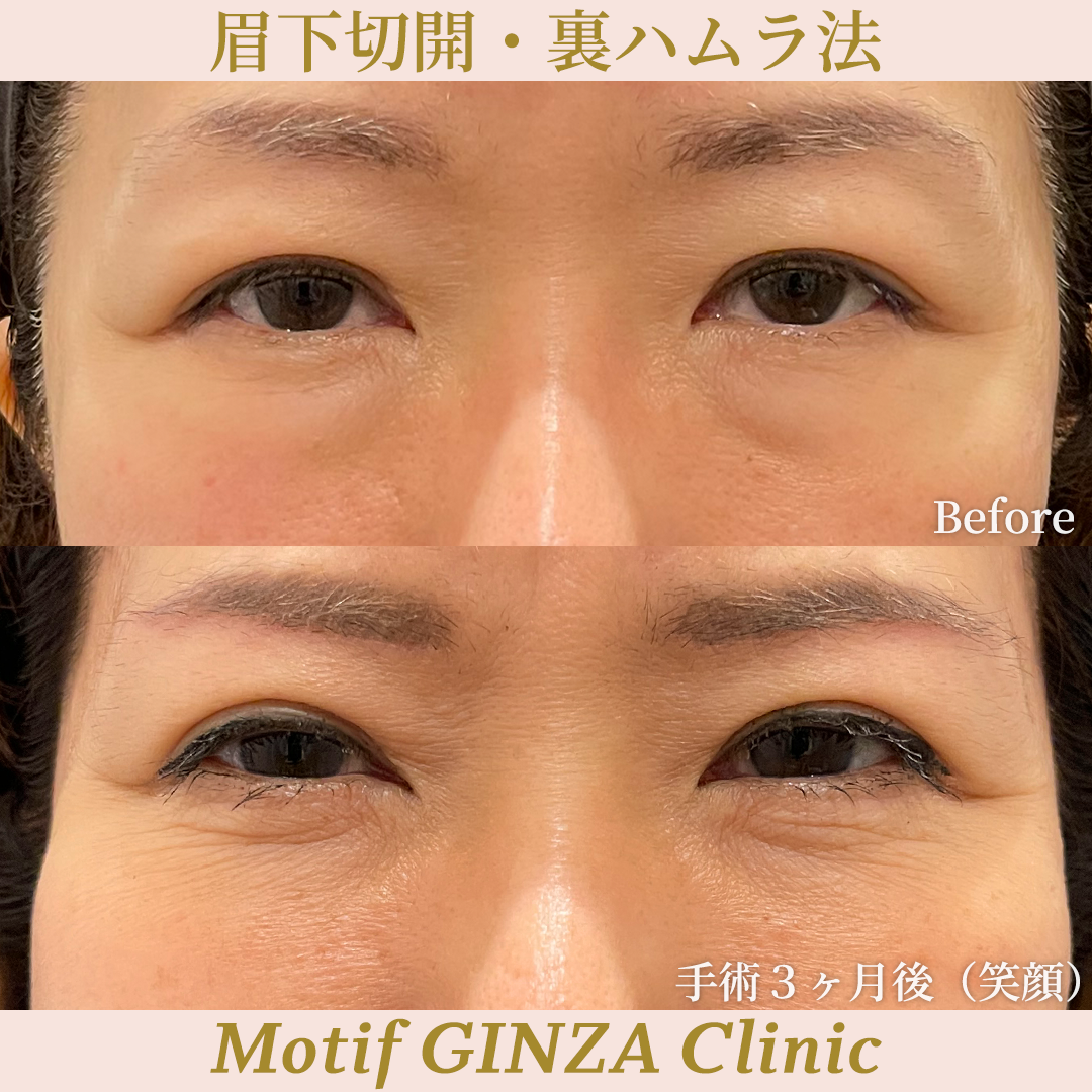 眉下切開・裏ハムラ法（手術３ヶ月）の写真2