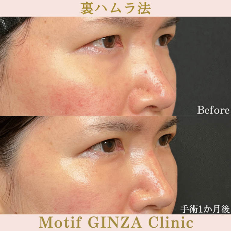 裏ハムラ法（手術３か月）の写真4