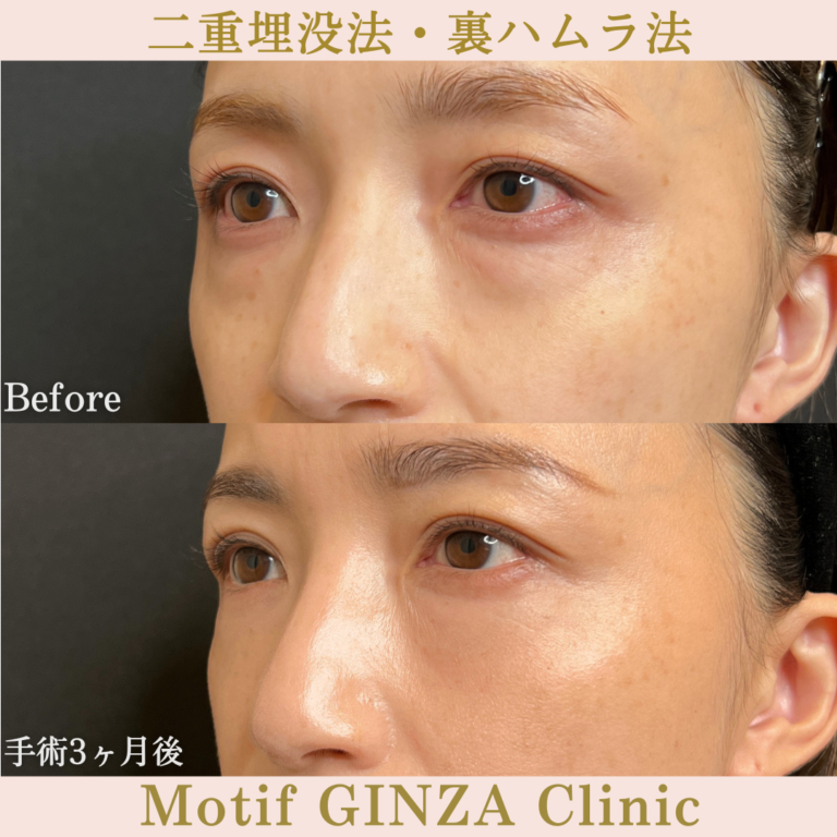 二重埋没法・裏ハムラ法（手術３か月）の写真2