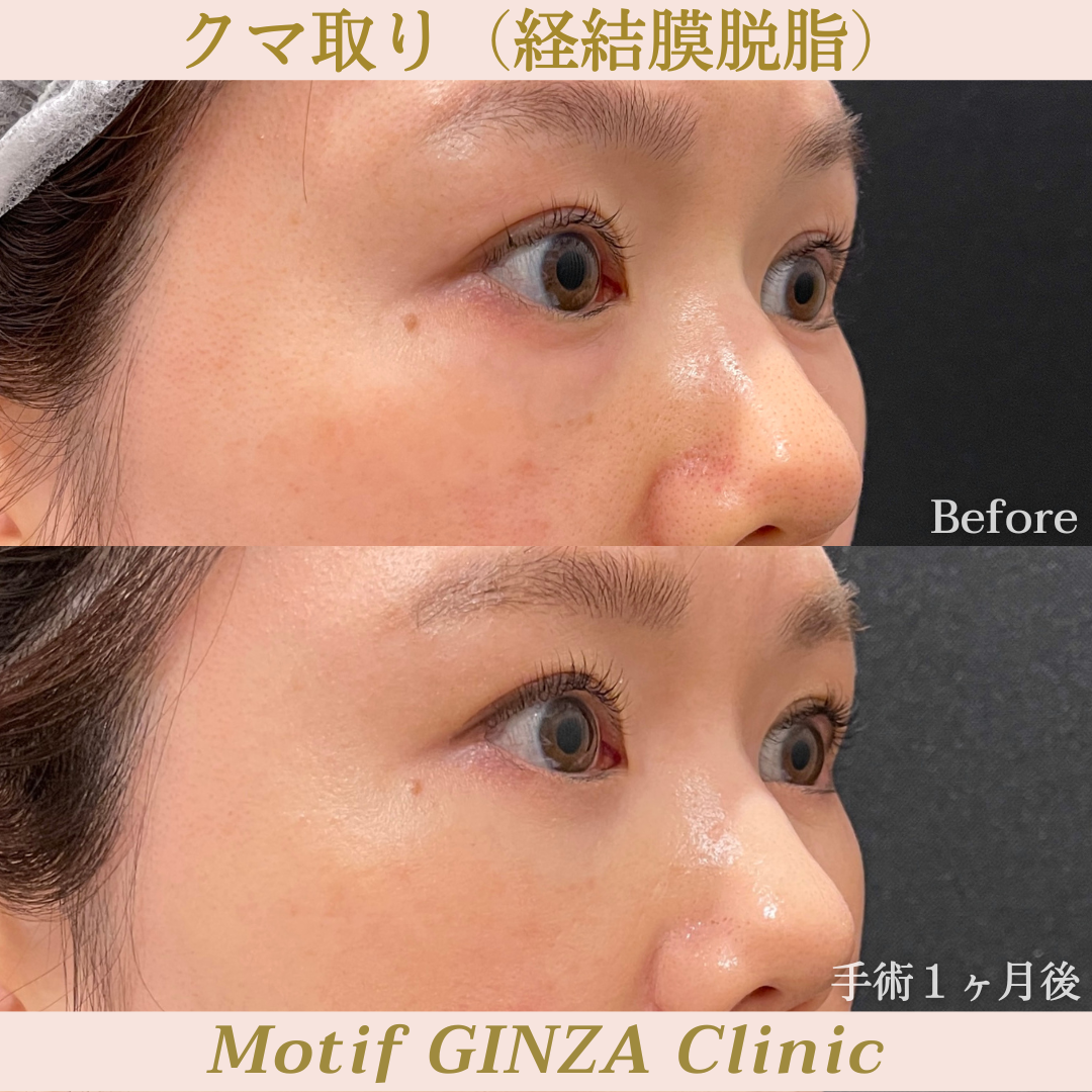 経結膜脱脂(手術1ヶ月)の写真2