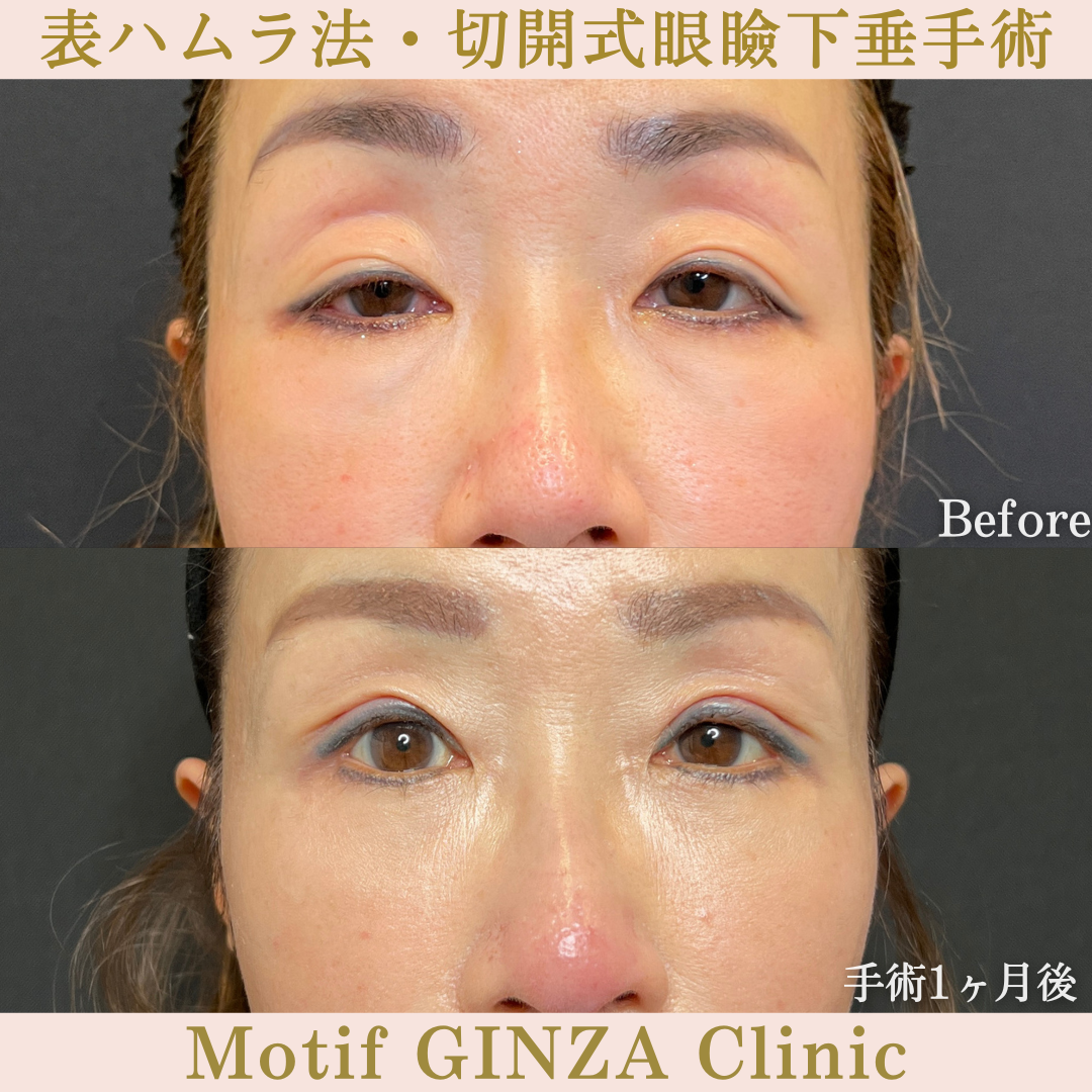 表ハムラ法・切開式眼瞼下垂手術(手術6ヶ月)の写真3