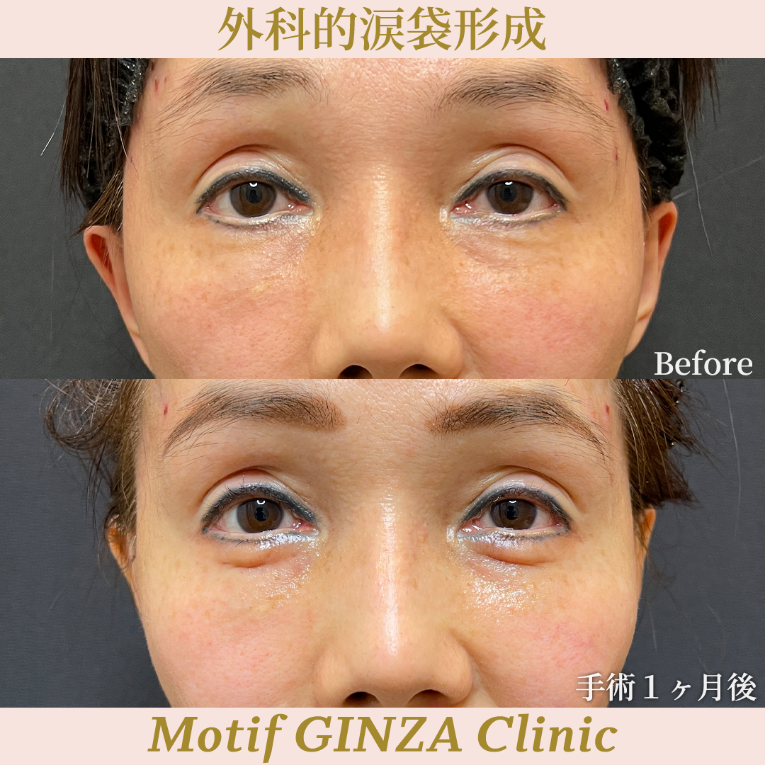 外科的涙袋形成(手術3ヶ月)の写真2