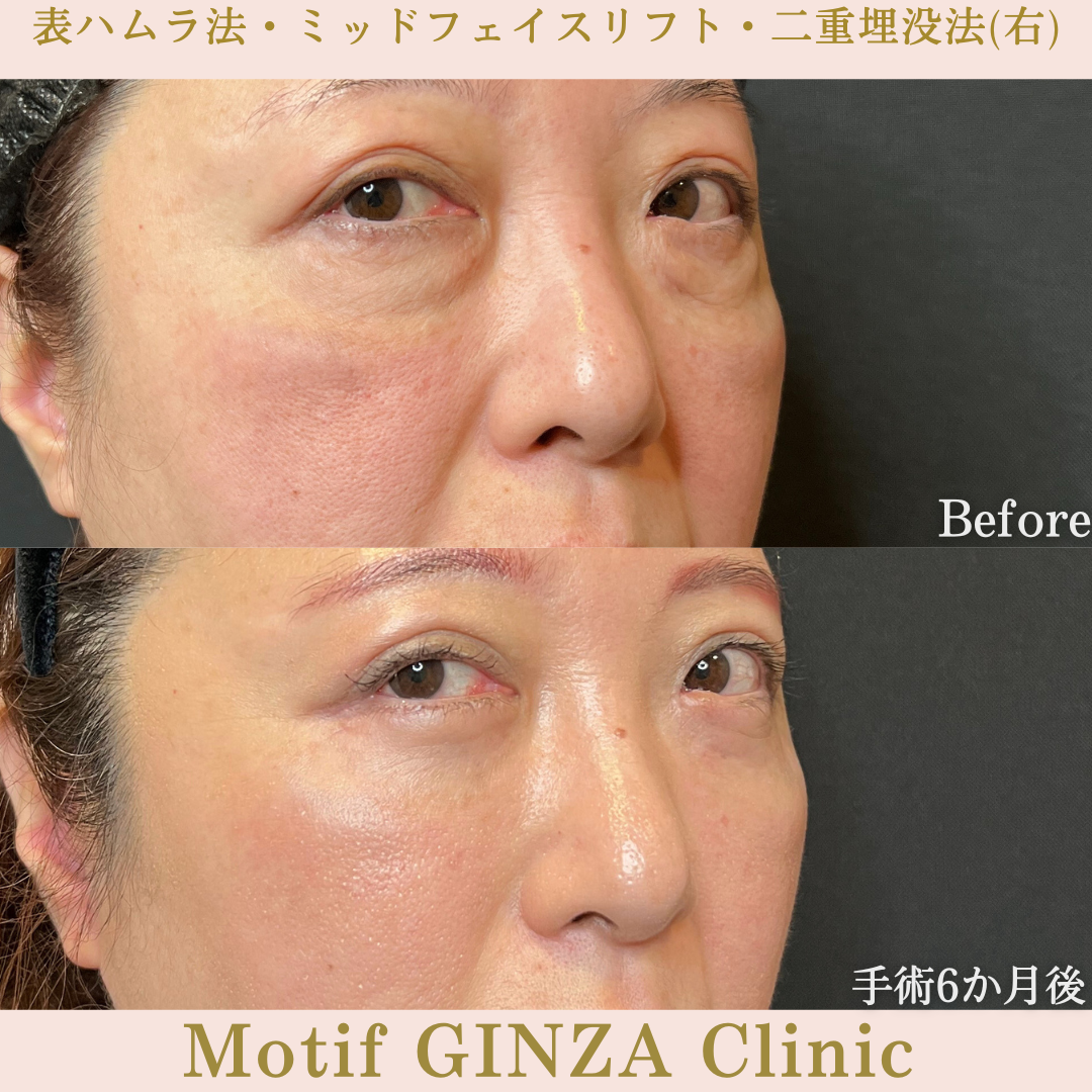 切開式下眼瞼たるみ取り・ミッドフェイスリフト・二重埋没法（手術６か月）の写真2