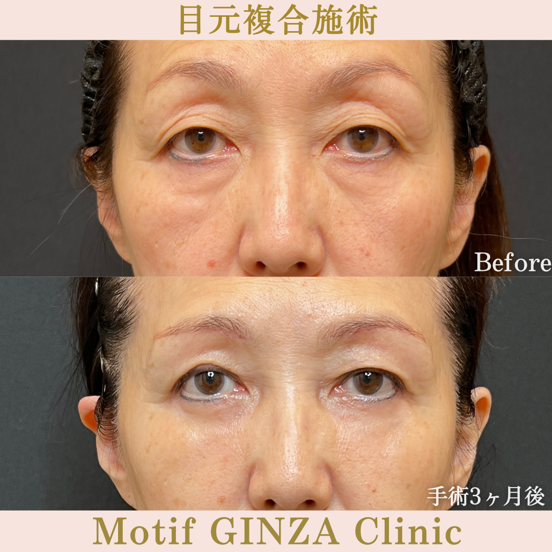 目元複合手術(手術6ヶ月)の写真3