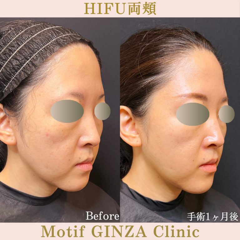 HIFU両頬（手術１ヶ月）の写真2
