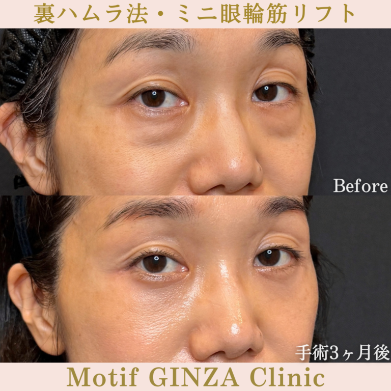裏ハムラ法・ミニ眼輪筋リフト（手術３か月）の写真2