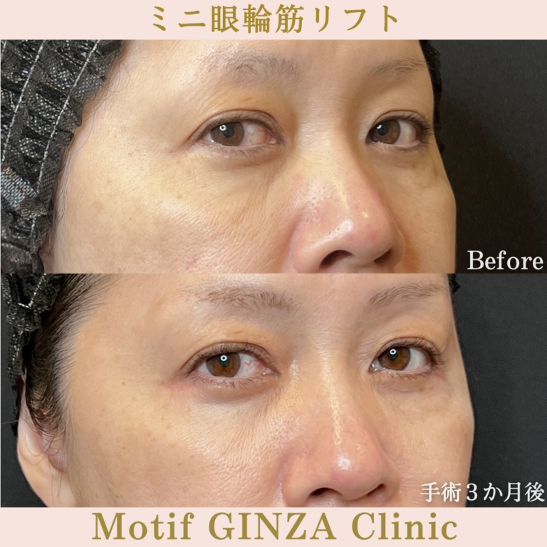 ミニ眼輪筋リフト（手術３か月）の写真2