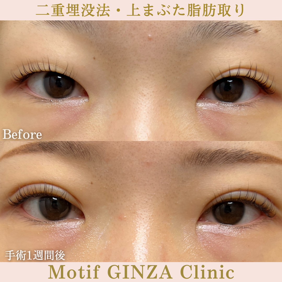 二重埋没法・上まぶた脂肪取り(手術1ヶ月)の写真2