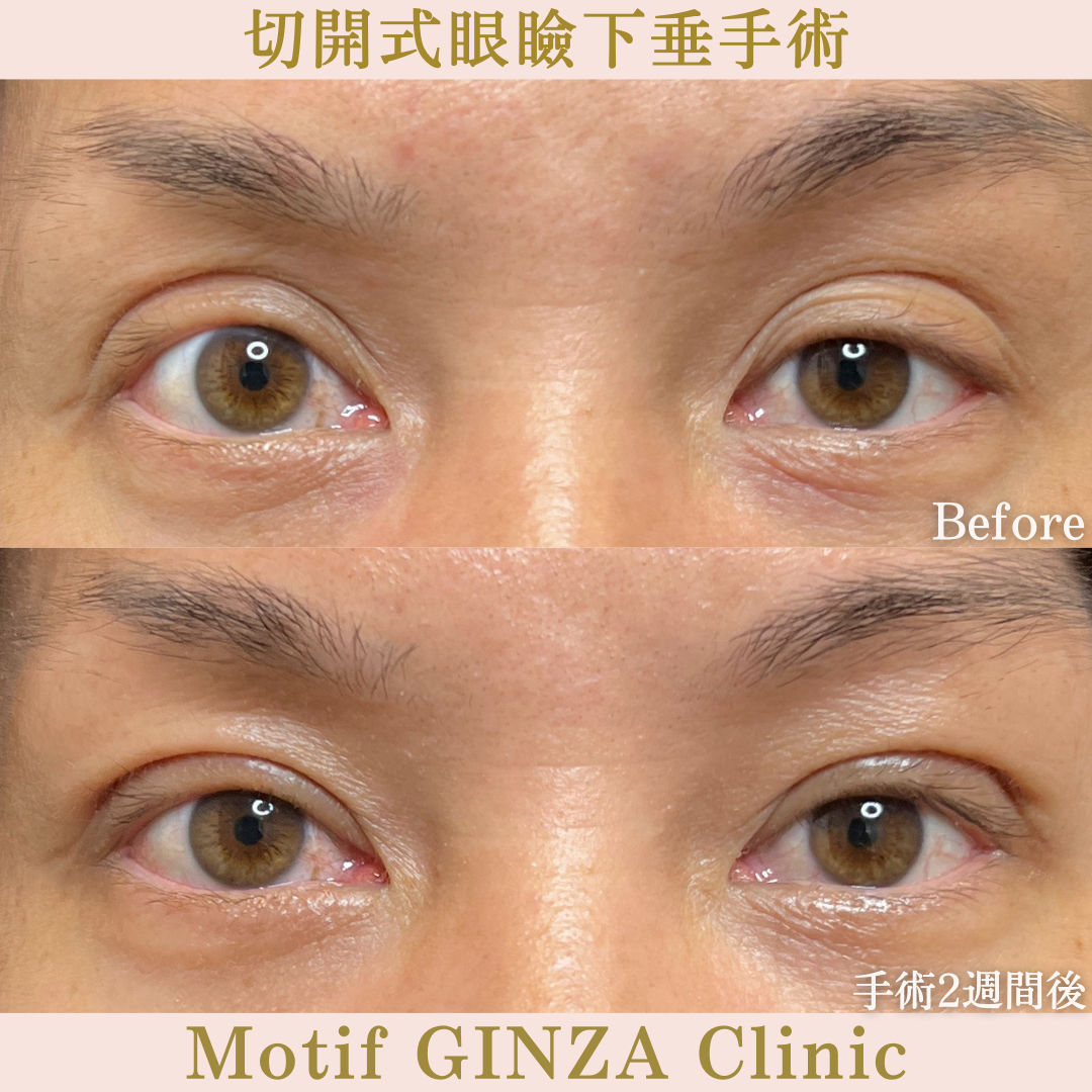 切開式眼瞼下垂手術（手術２週間）の写真