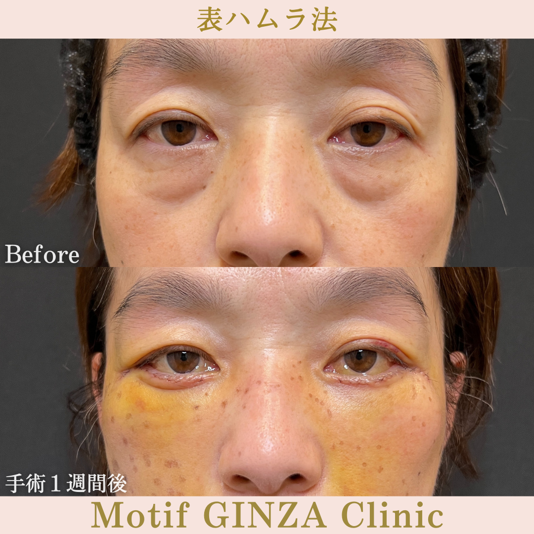 切開式下眼瞼たるみ取り・ミッドフェイスリフト（手術３ヶ月）の写真4