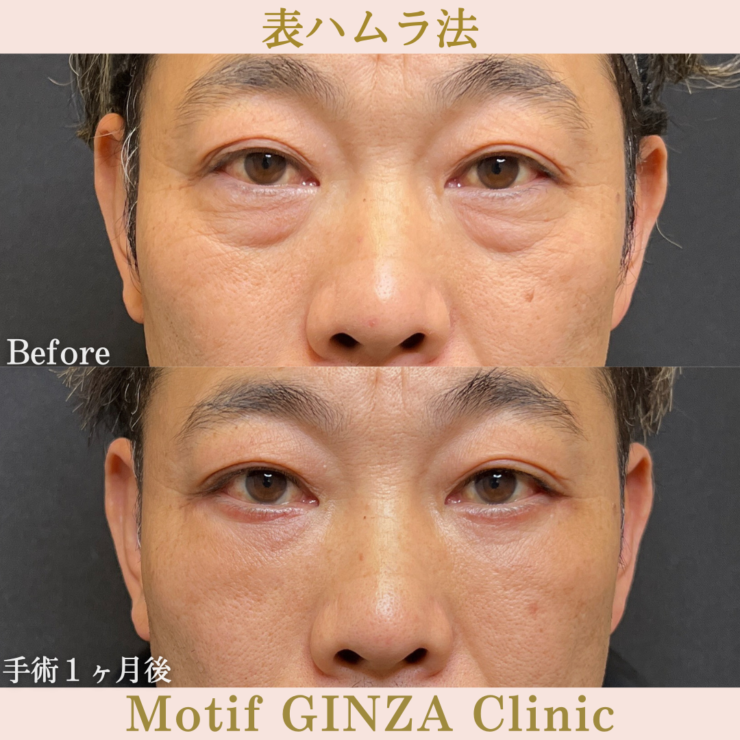 切開式下眼瞼たるみ取り(手術6ヶ月)の写真3