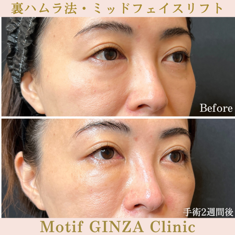 裏ハムラ法・ミッドフェイスリフト（手術３か月）の写真6