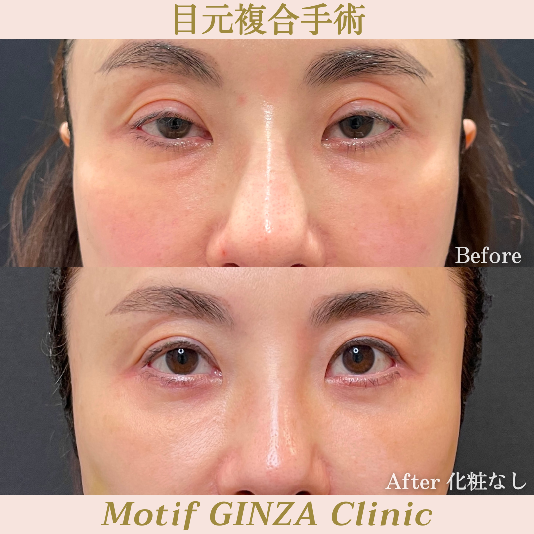 目元複合手術の写真