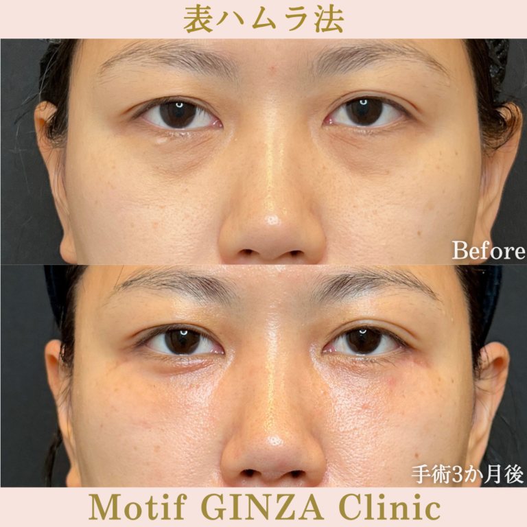 表ハムラ法（手術３か月）