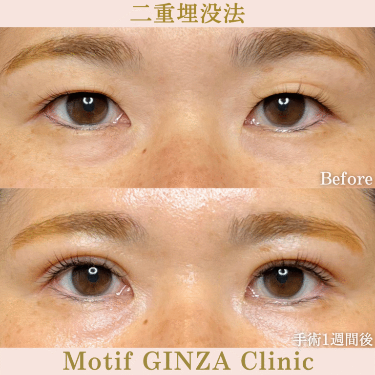 二重埋没法（手術１か月）の写真2