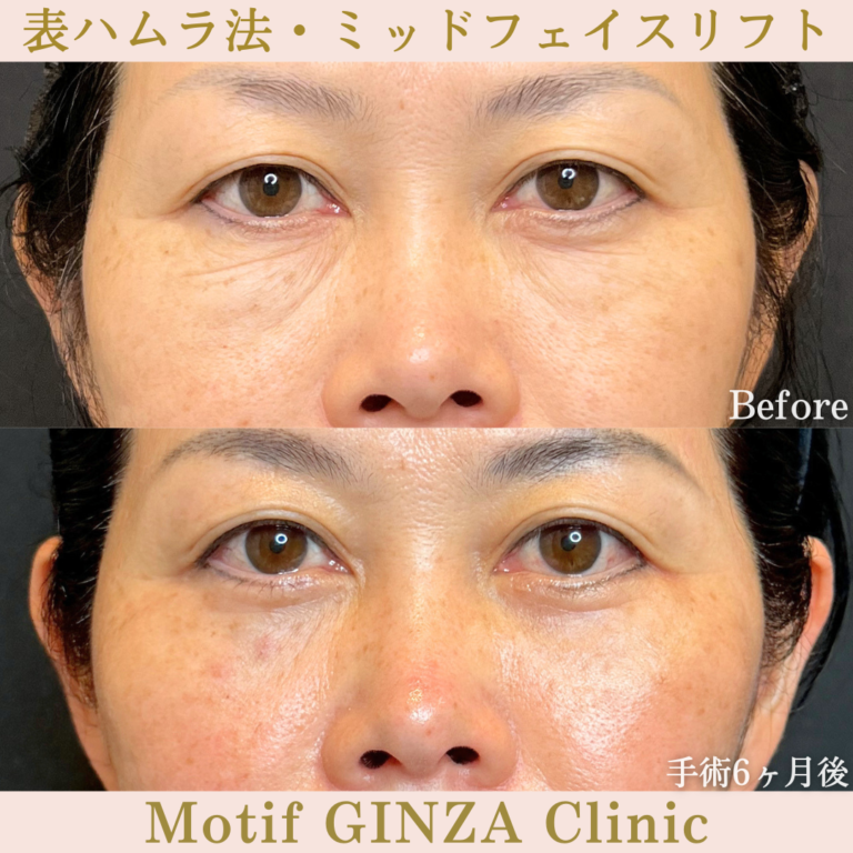 表ハムラ法・ミッドフェイスリフト（手術6か月）