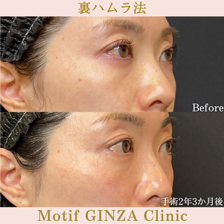 裏ハムラ法（手術2年３ヶ月）の写真2