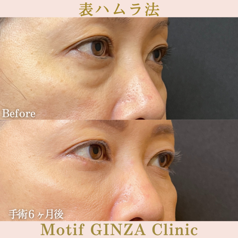 切開式下眼瞼たるみ取り（手術2年6か月）の写真6