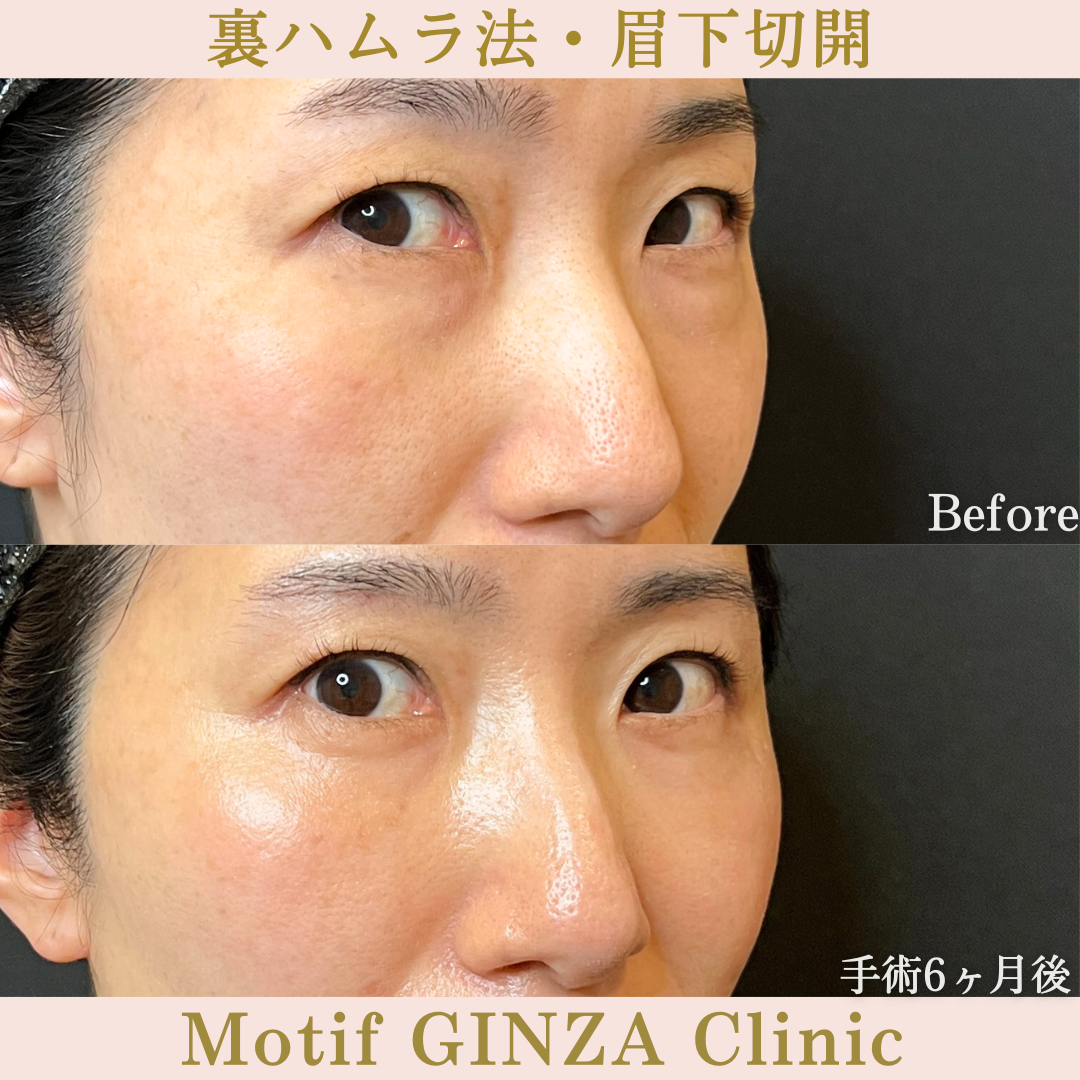 裏ハムラ法・眉下切開(手術6か月)の写真2