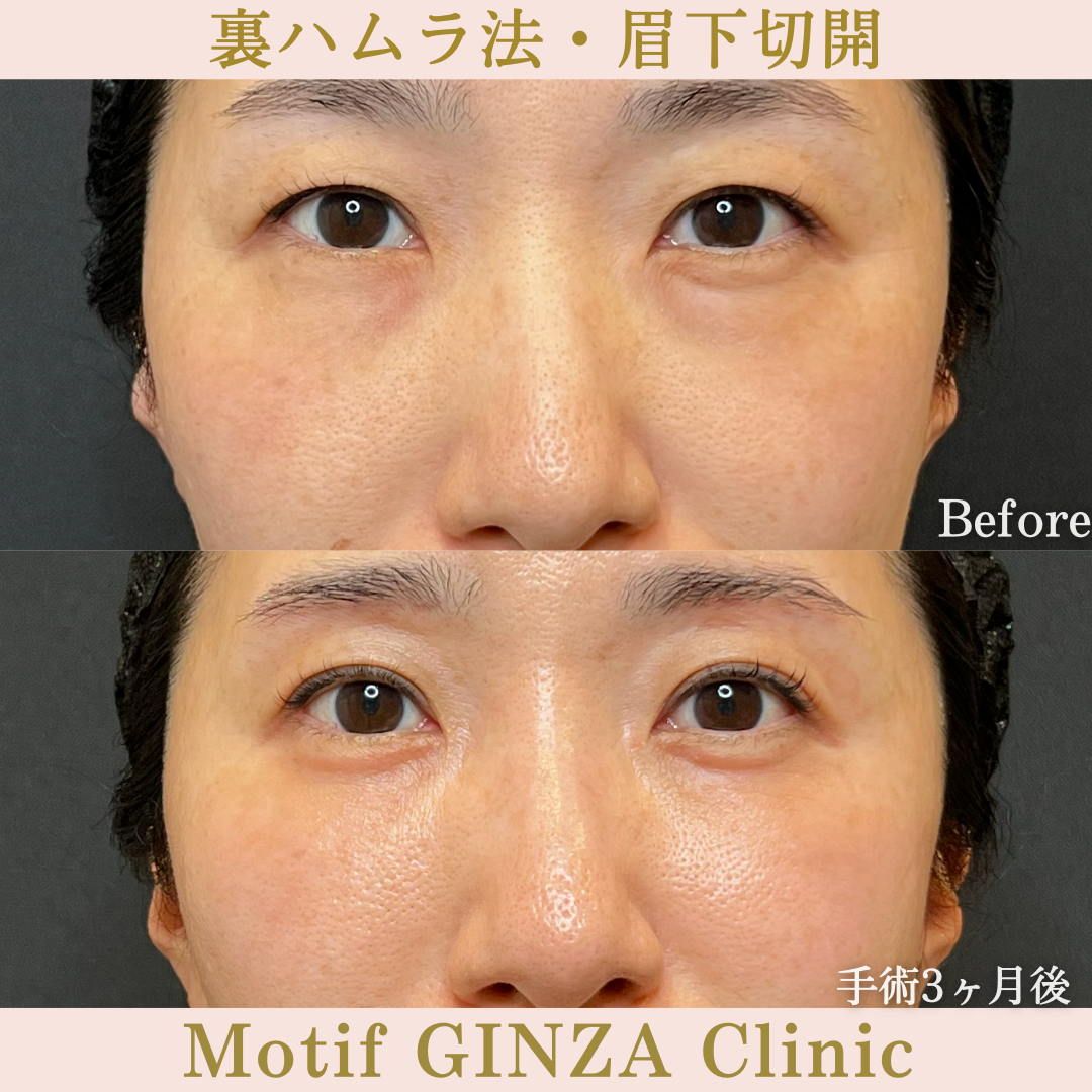 裏ハムラ法・眉下切開(手術6か月)の写真3