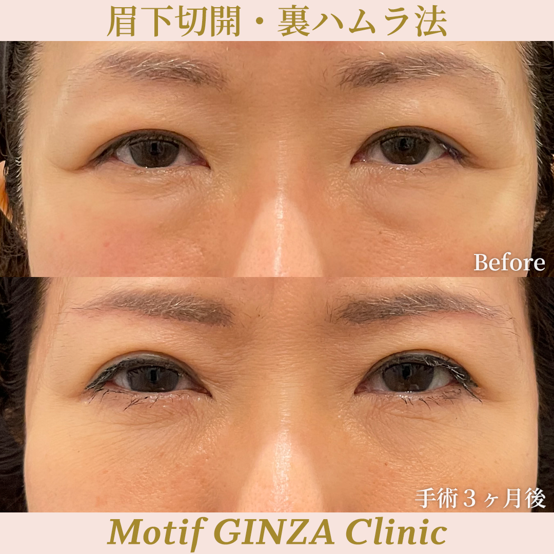 眉下切開・裏ハムラ法（手術３ヶ月）の写真