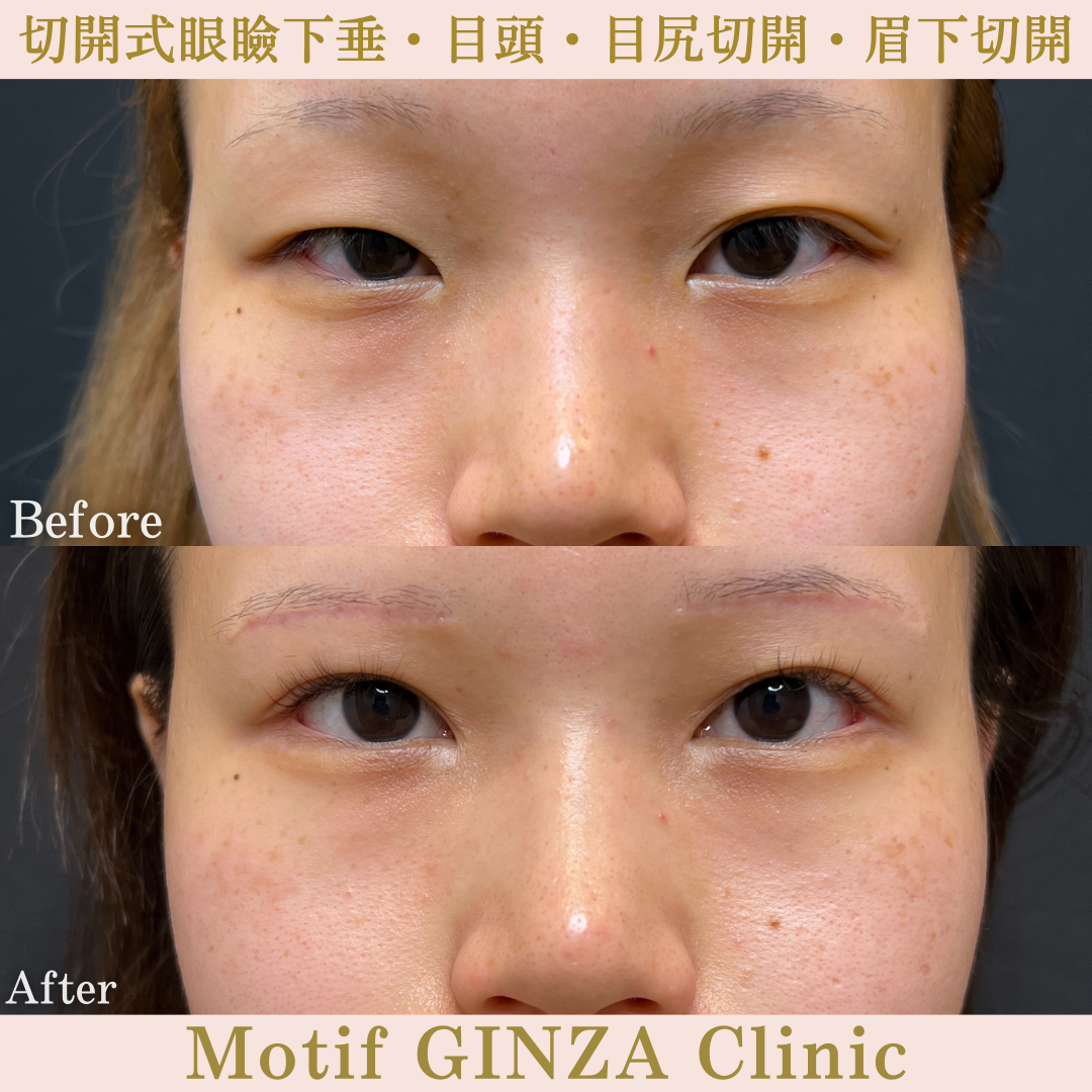 切開式眼瞼下垂・目頭切開・目尻切開・眉下切開（手術10ヶ月）の写真
