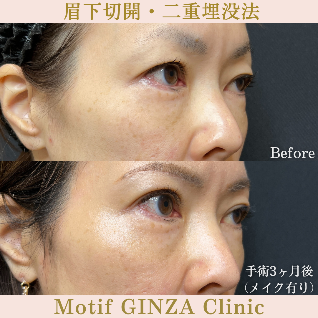 眉下切開・二重埋没法（手術３ヶ月）の写真2