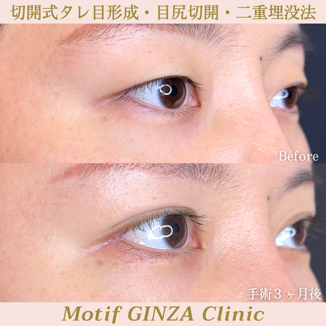 タレ目形成・目尻切開・二重埋没法(手術3ヶ月)の写真3
