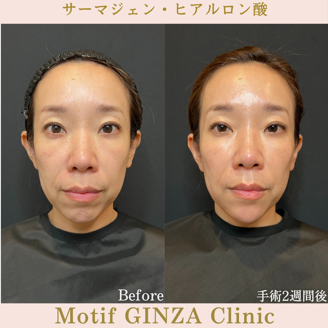 サーマジェン・ヒアルロン酸（手術１か月）の写真4