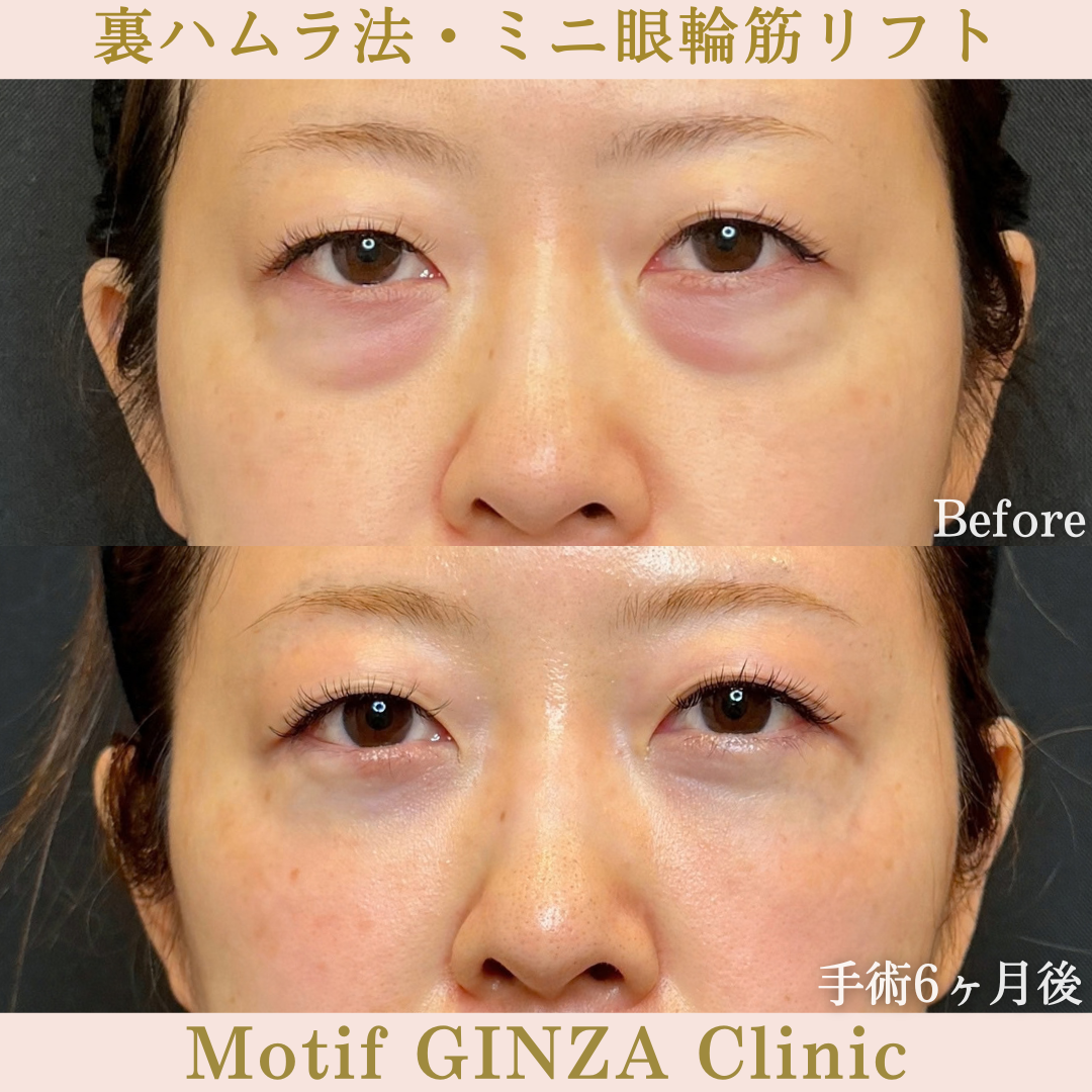 裏ハムラ法・ミニ眼輪筋リフト（手術6か月）の写真