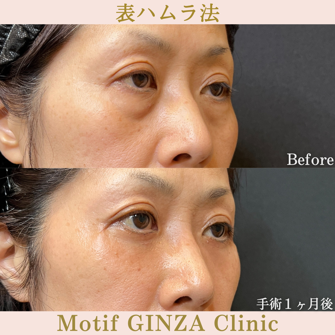 切開式下眼瞼たるみ取り(手術3ヶ月)の写真4