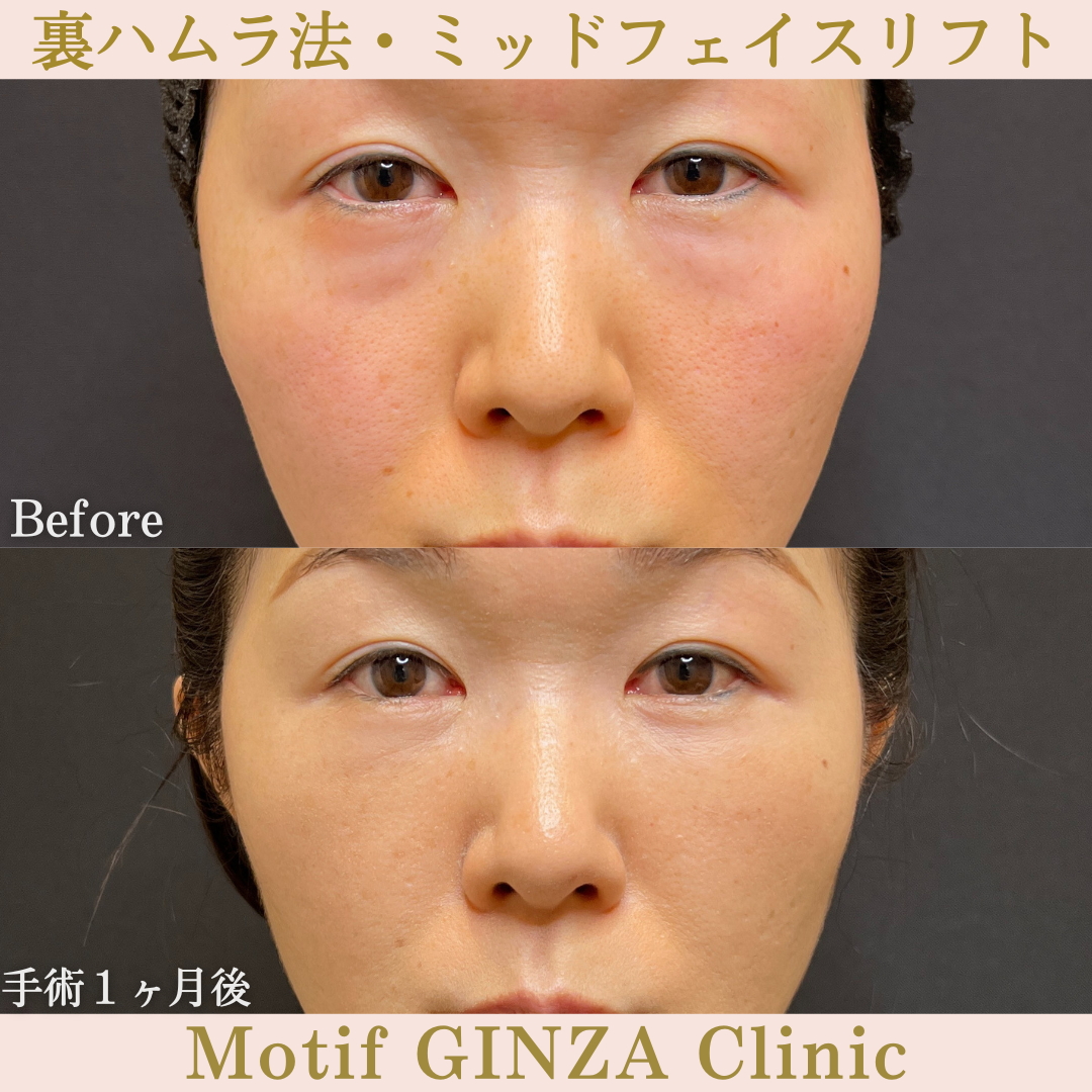 裏ハムラ法・ミッドフェイスリフト(手術6ヶ月)の写真3