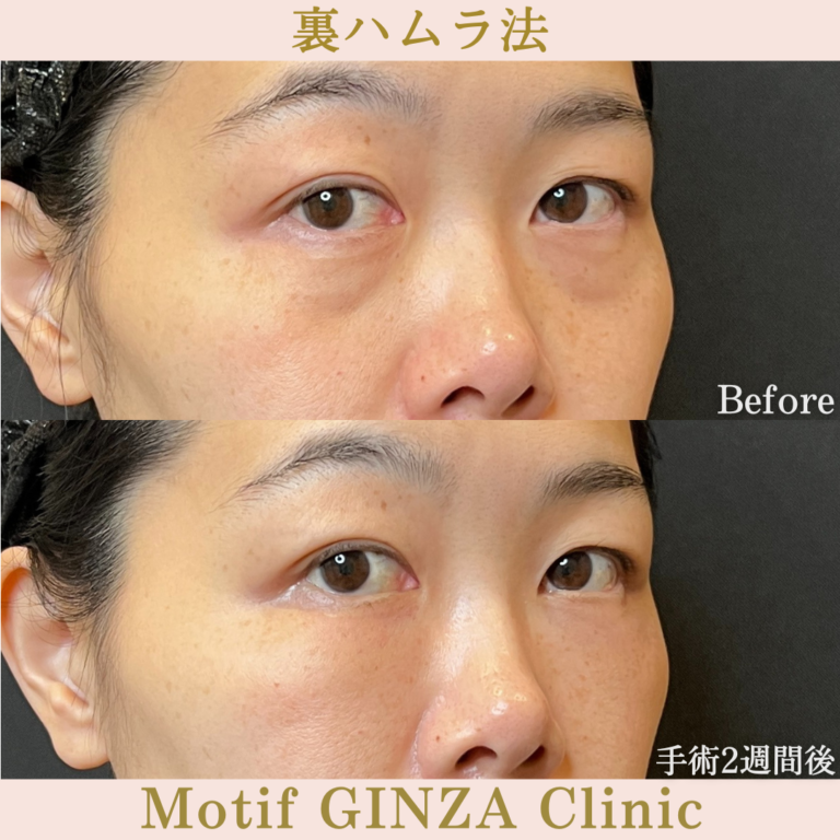 裏ハムラ法(手術1か月)の写真4