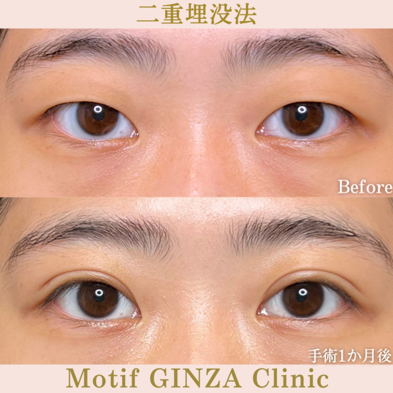 二重埋没法（手術１か月）