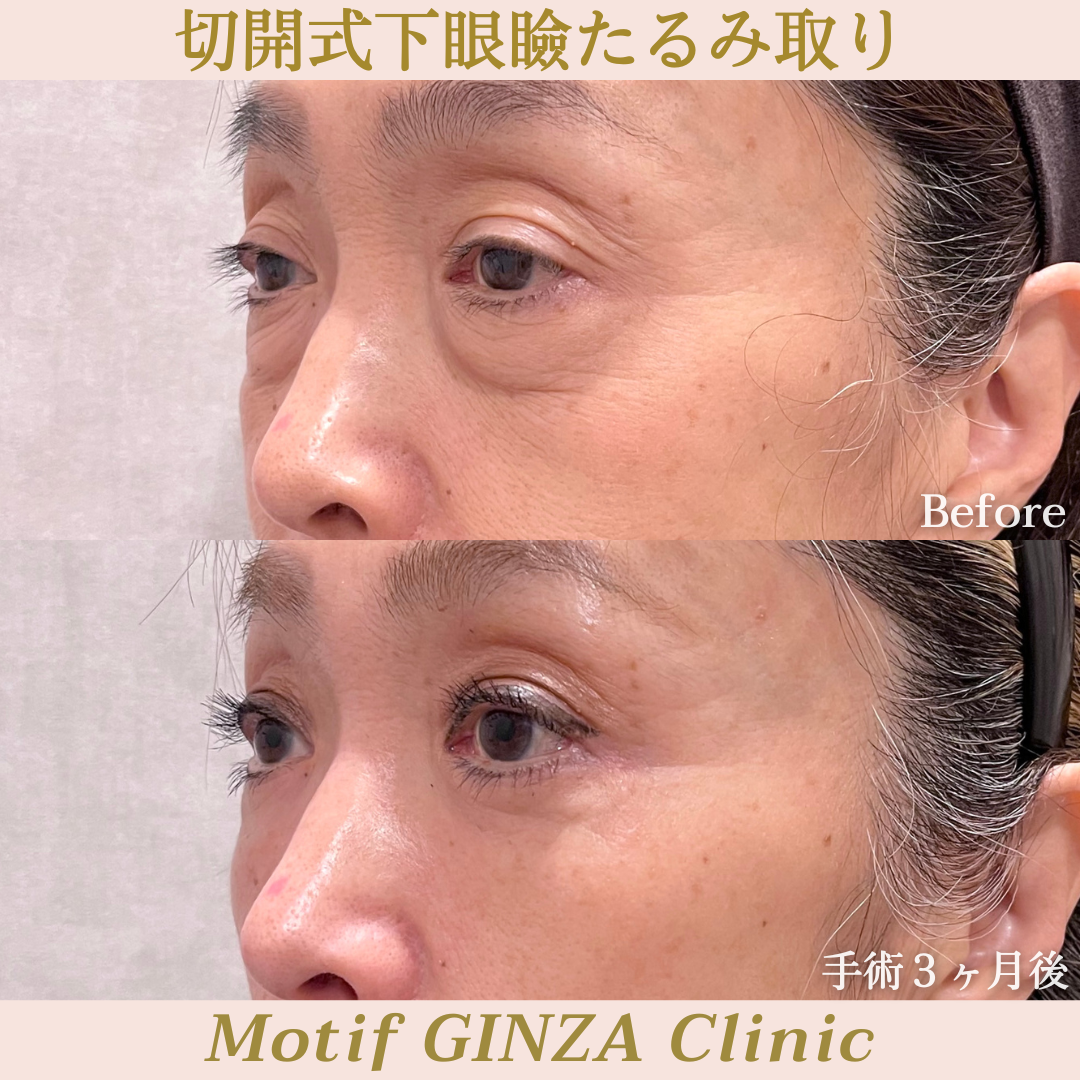 切開式下眼瞼たるみ取り(ハムラ法)(手術3ヶ月)の写真2