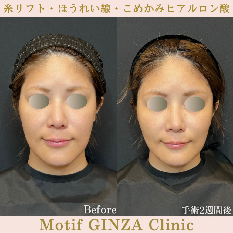 糸リフト・ほうれい線・こめかみヒアルロン酸(手術1か月)の写真3