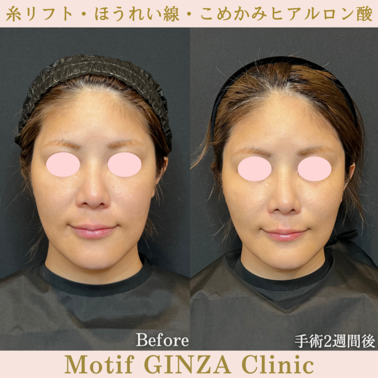 糸リフト・ほうれい線・こめかみヒアルロン酸（手術1か月）の写真3