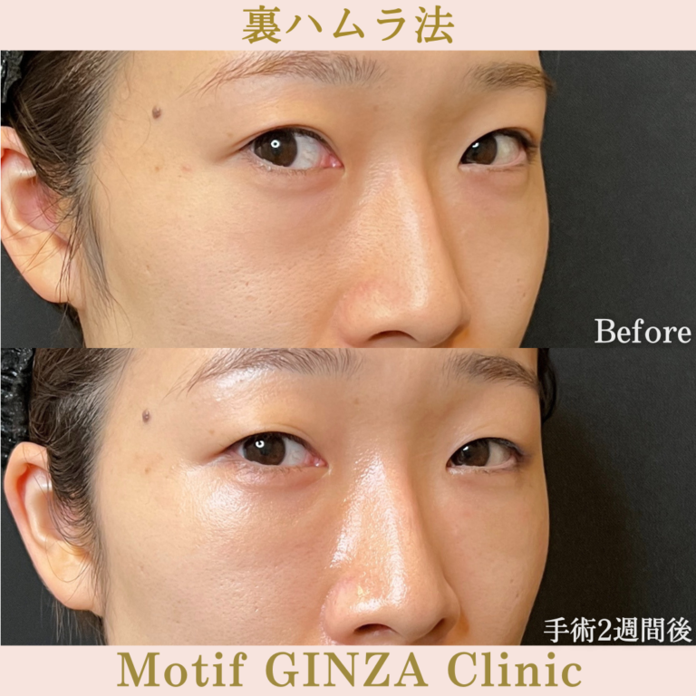 裏ハムラ法(手術1か月)の写真4