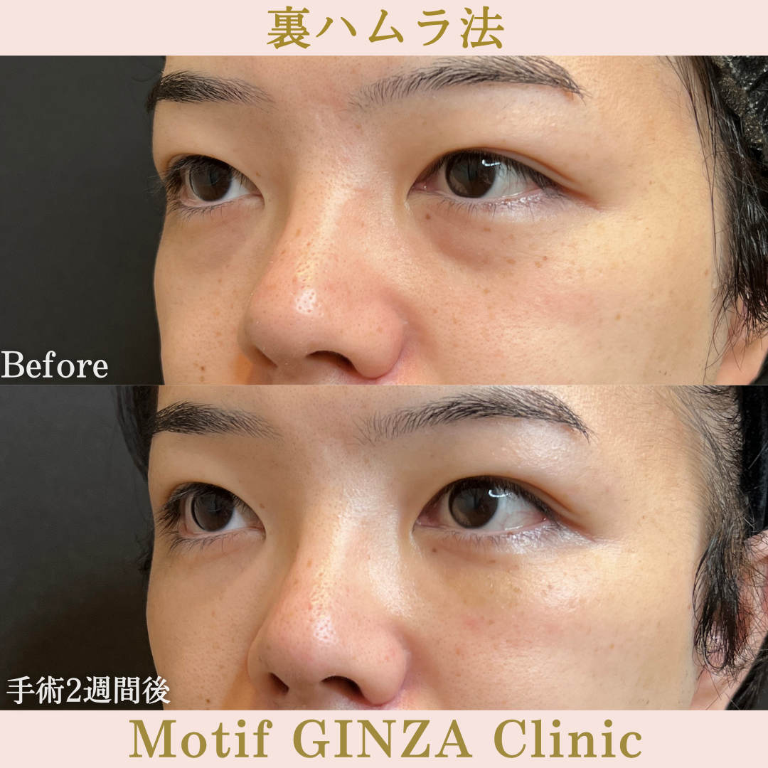 裏ハムラ法(手術3か月)の写真6