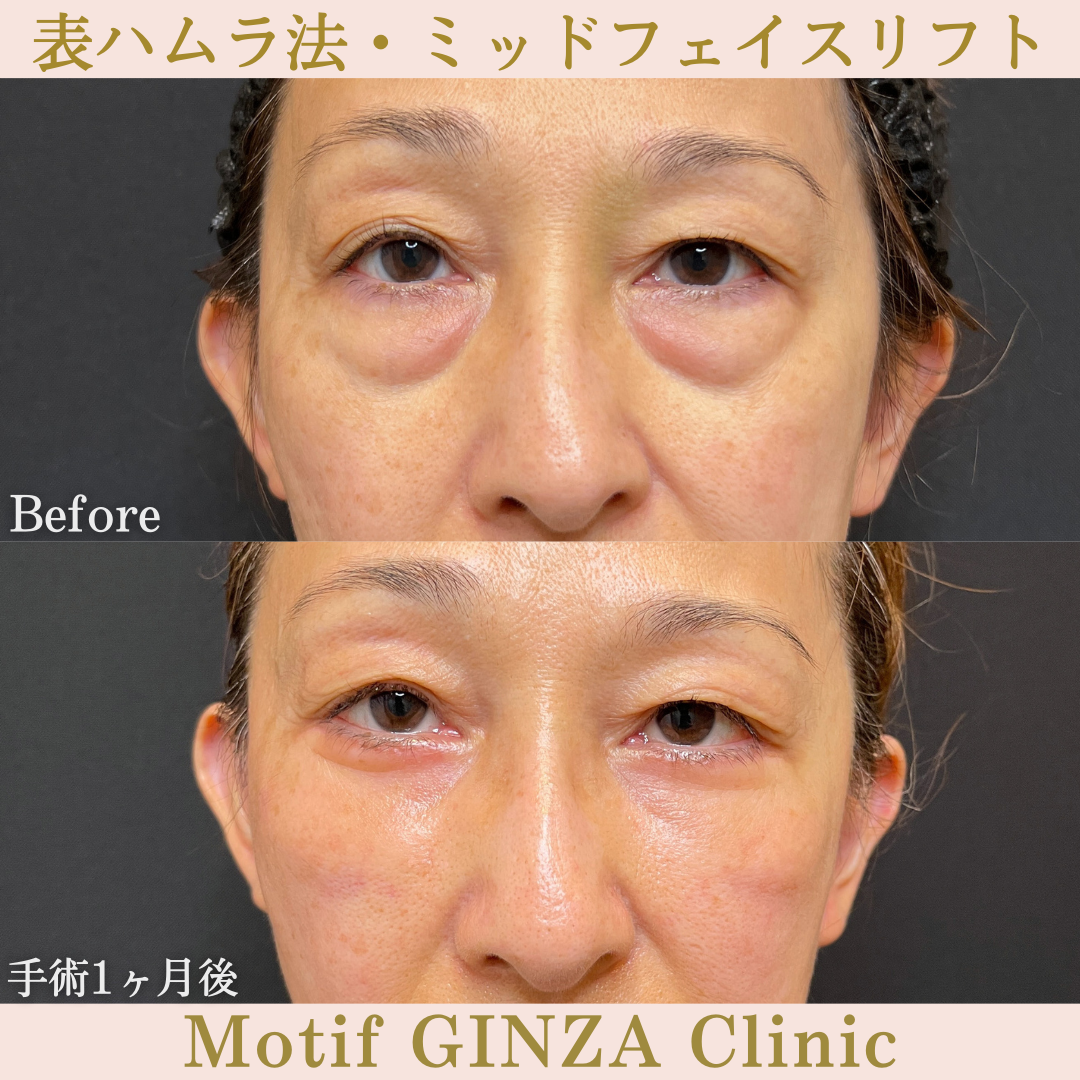 切開式下眼瞼たるみ取り・ミッドフェイスリフト(手術3ヶ月)の写真2