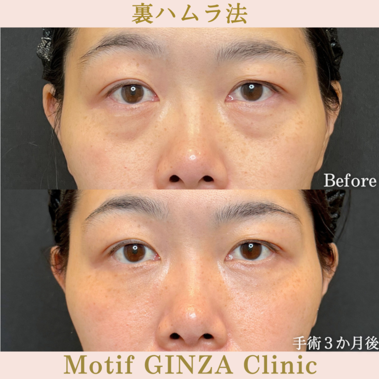 裏ハムラ法（手術3か月）