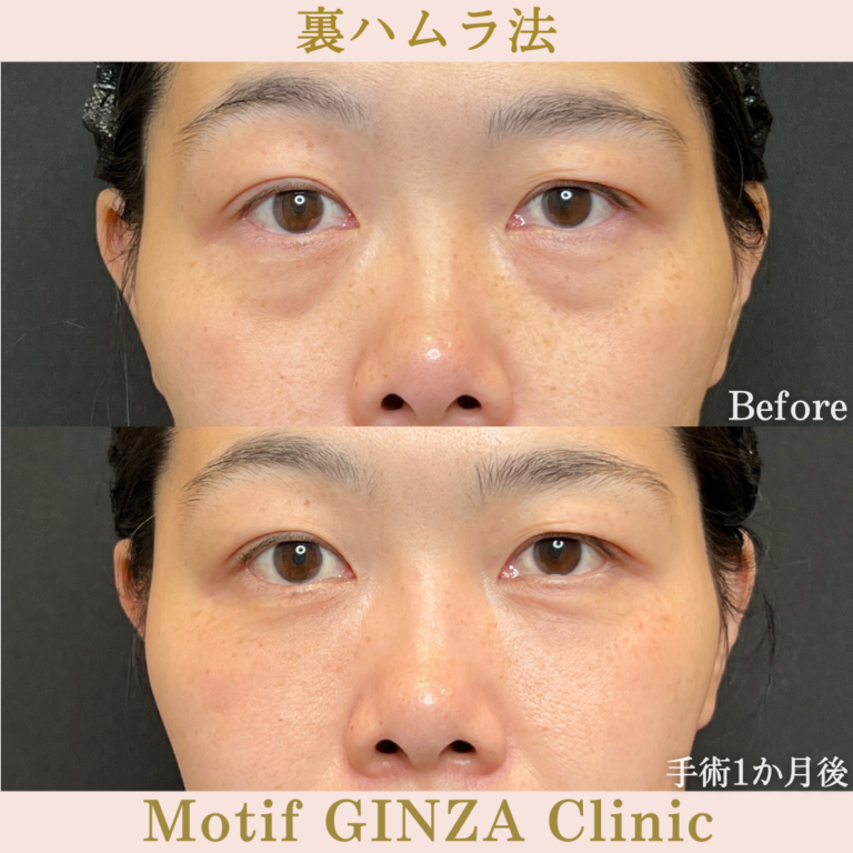 裏ハムラ法（手術１か月）